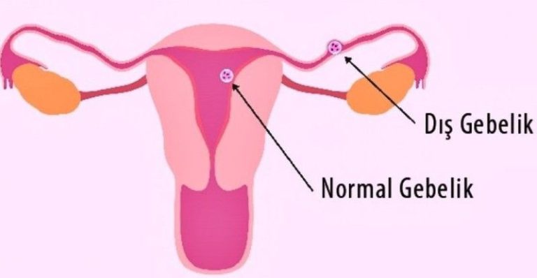 Dış Gebelik Nedir? Dış Gebelik Belirtileri Nelerdir?