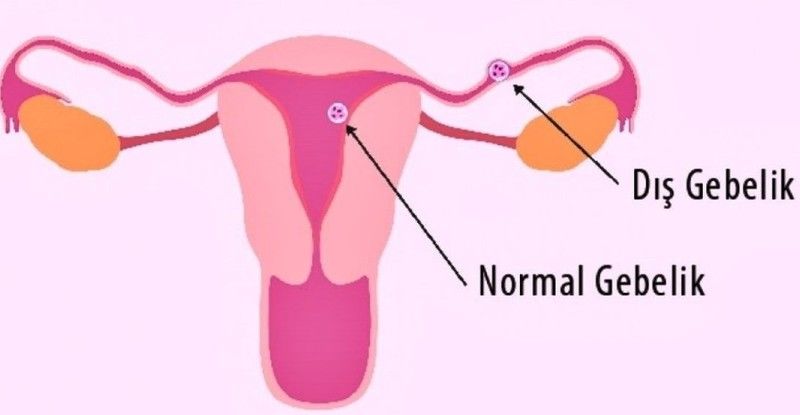 Dış Gebelik Nedir? Dış Gebelik Belirtileri Nelerdir?