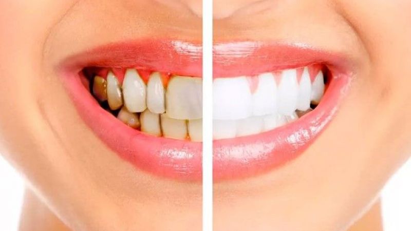 Diş Taşı Temizliği Nedir, Zararlı Mıdır? Faydalı Mıdır?