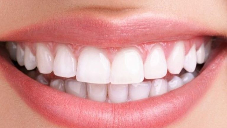 Estetik Gülüş Tasarımı Nedir, Nasıl Yapılır?
