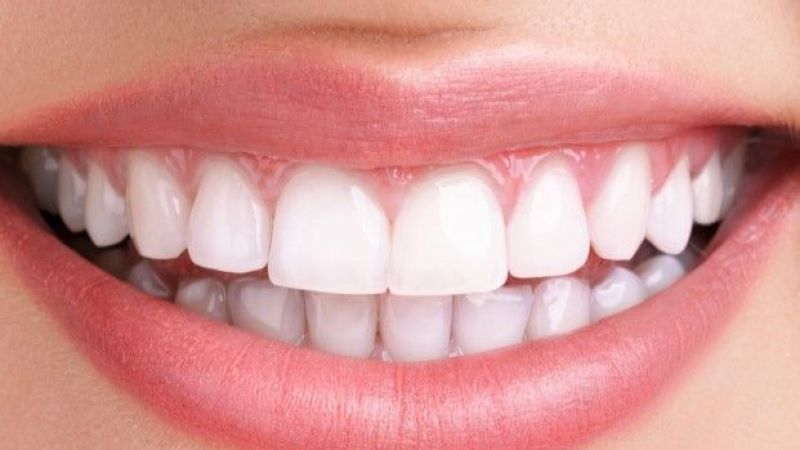 Estetik Gülüş Tasarımı Nedir, Nasıl Yapılır?