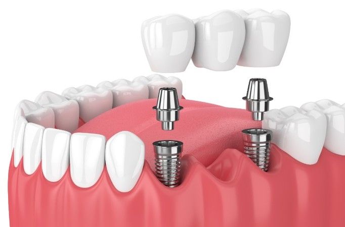 İmplant Nedir? Devlet, SGK İmplant Karışılıyor mu?