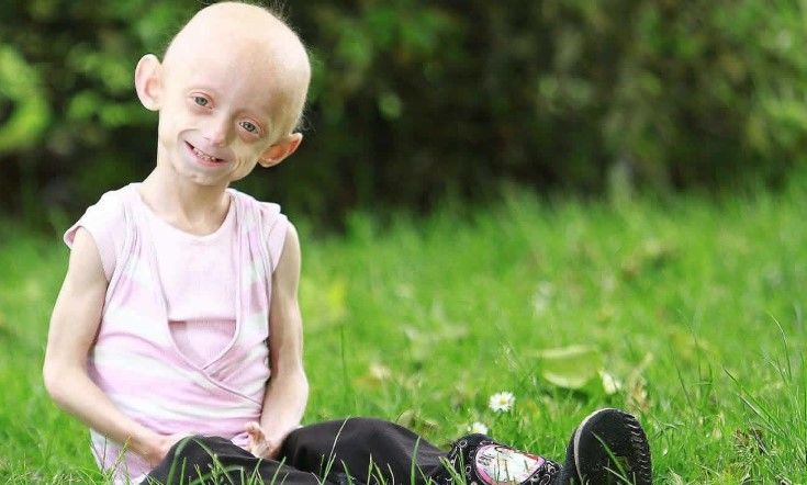 Progeria Hastalığı Sendromu Nedir? Neden Olur?