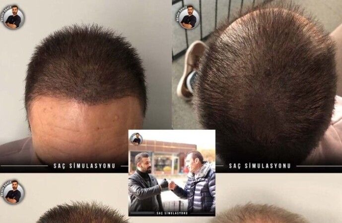Saç Simülasyonunun Faydaları Nelerdir?