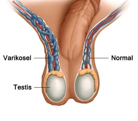 Varikosel Nedir? Belirtileri ve Tedavileri