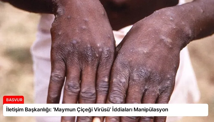İletişim Başkanlığı: ‘Maymun Çiçeği Virüsü’ İddiaları Manipülasyon