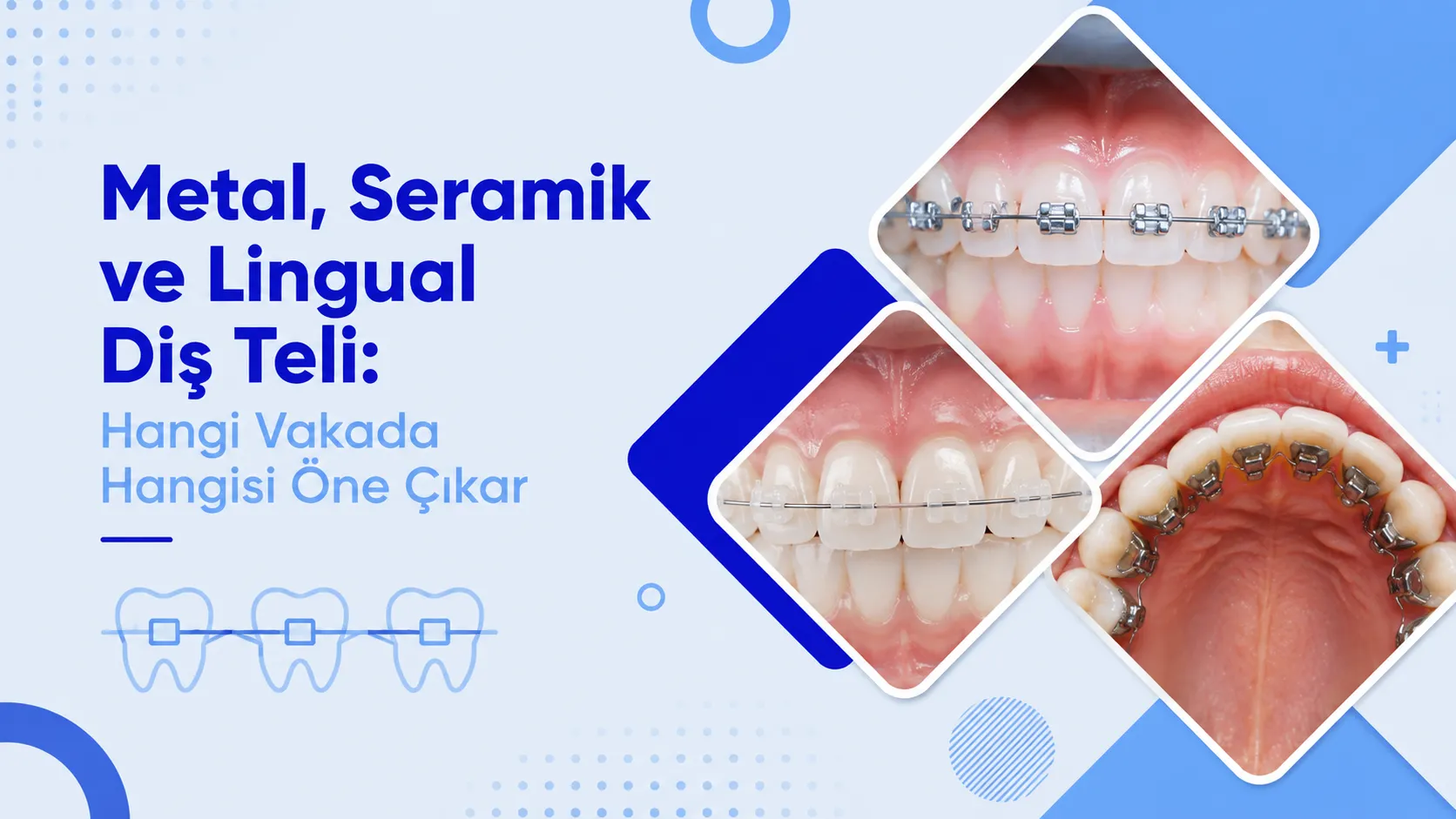 Metal, Seramik ve Lingual Diş Teli: Hangi Vakada Hangisi Öne Çıkar